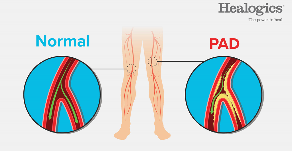 peripheral-artery-disease-fauquier-health-wound-center